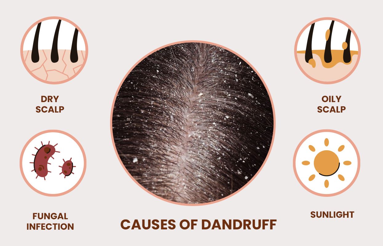 Infographics with causes of dandruff