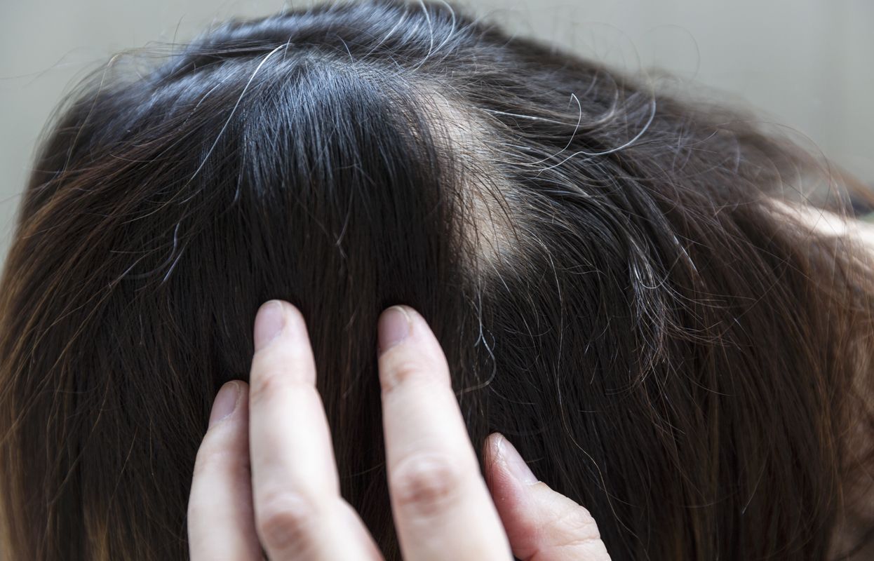 a woman irritated with bald hair loss and bald patches