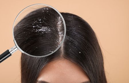 Girl with Dandruff on her hair