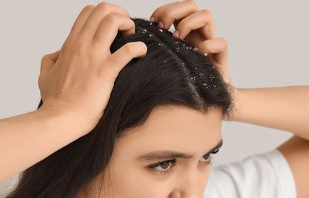 Girl concerned about Dandruff