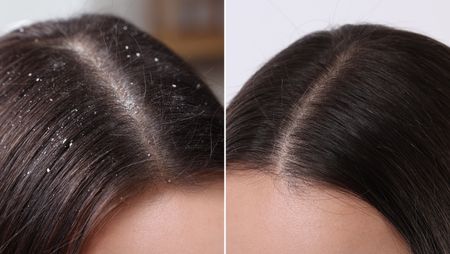 Dandruff on Oily Scalp