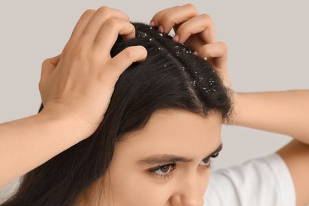 Girl with dandruff on hair