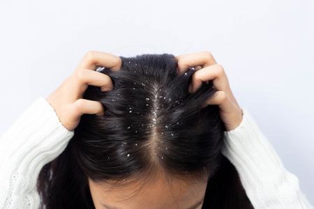 Girl with Dandruff in hair