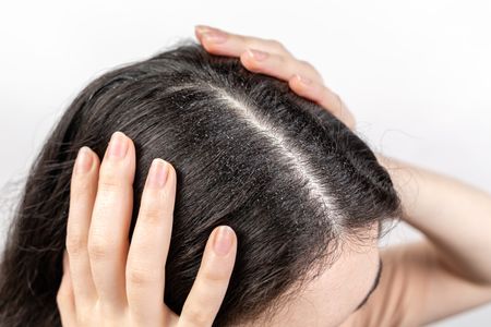 Girl with Scalp Buildup