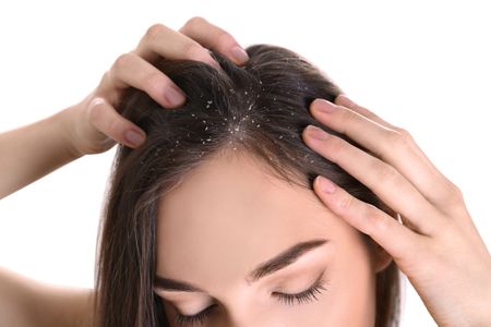 Dandruff in summer