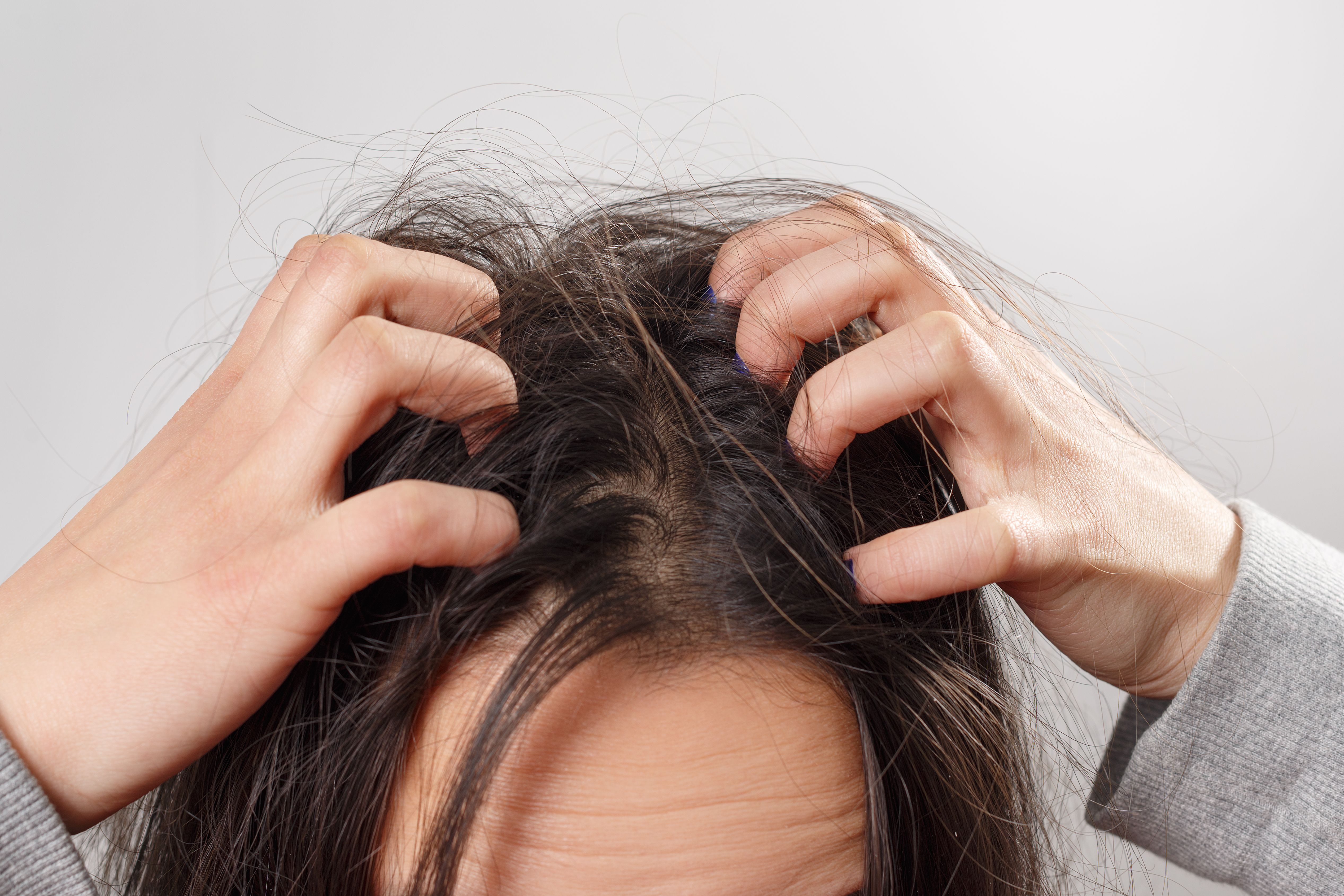 Causes of Dandruff in Hair