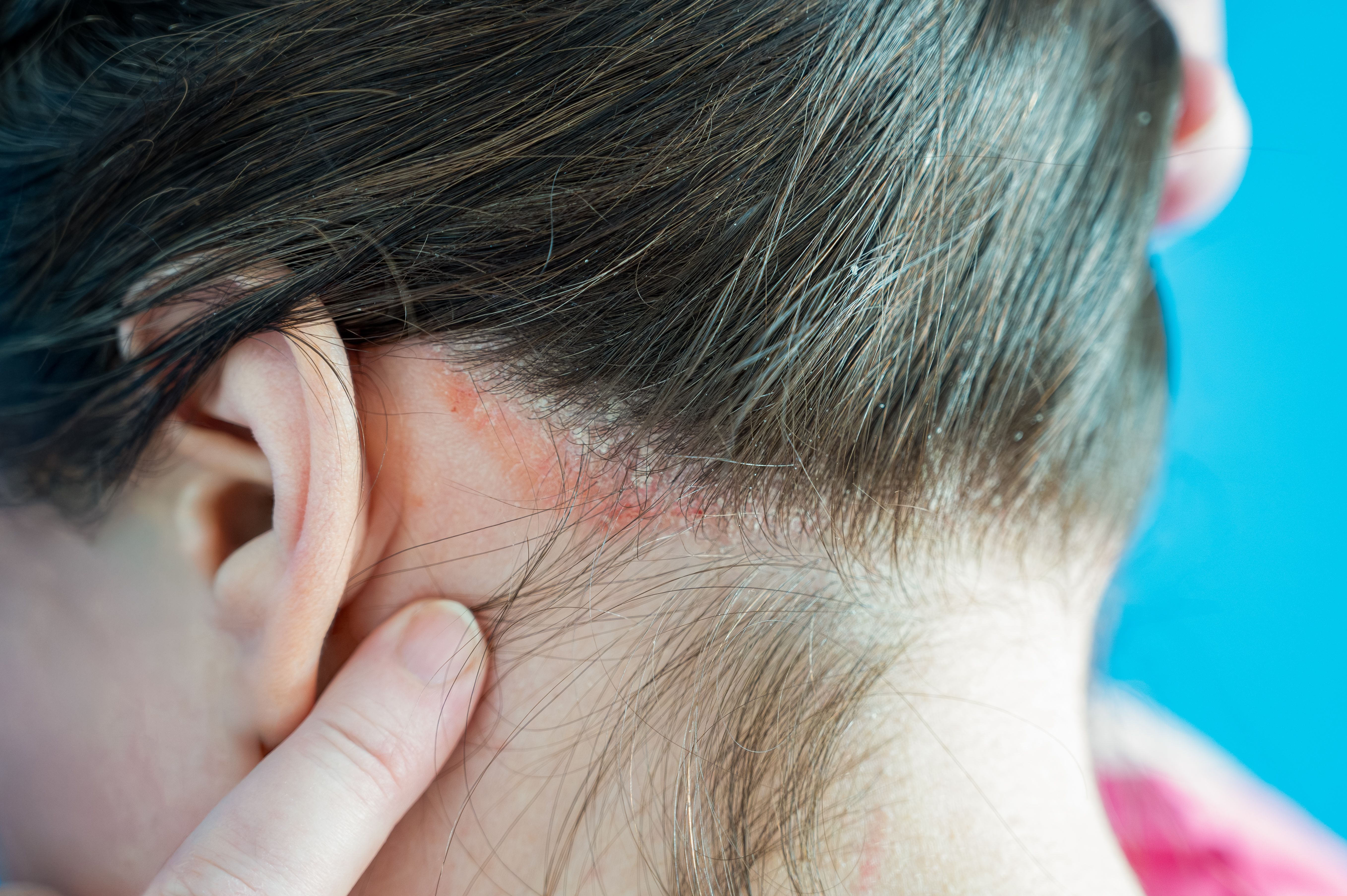 Dandruff from skin condition