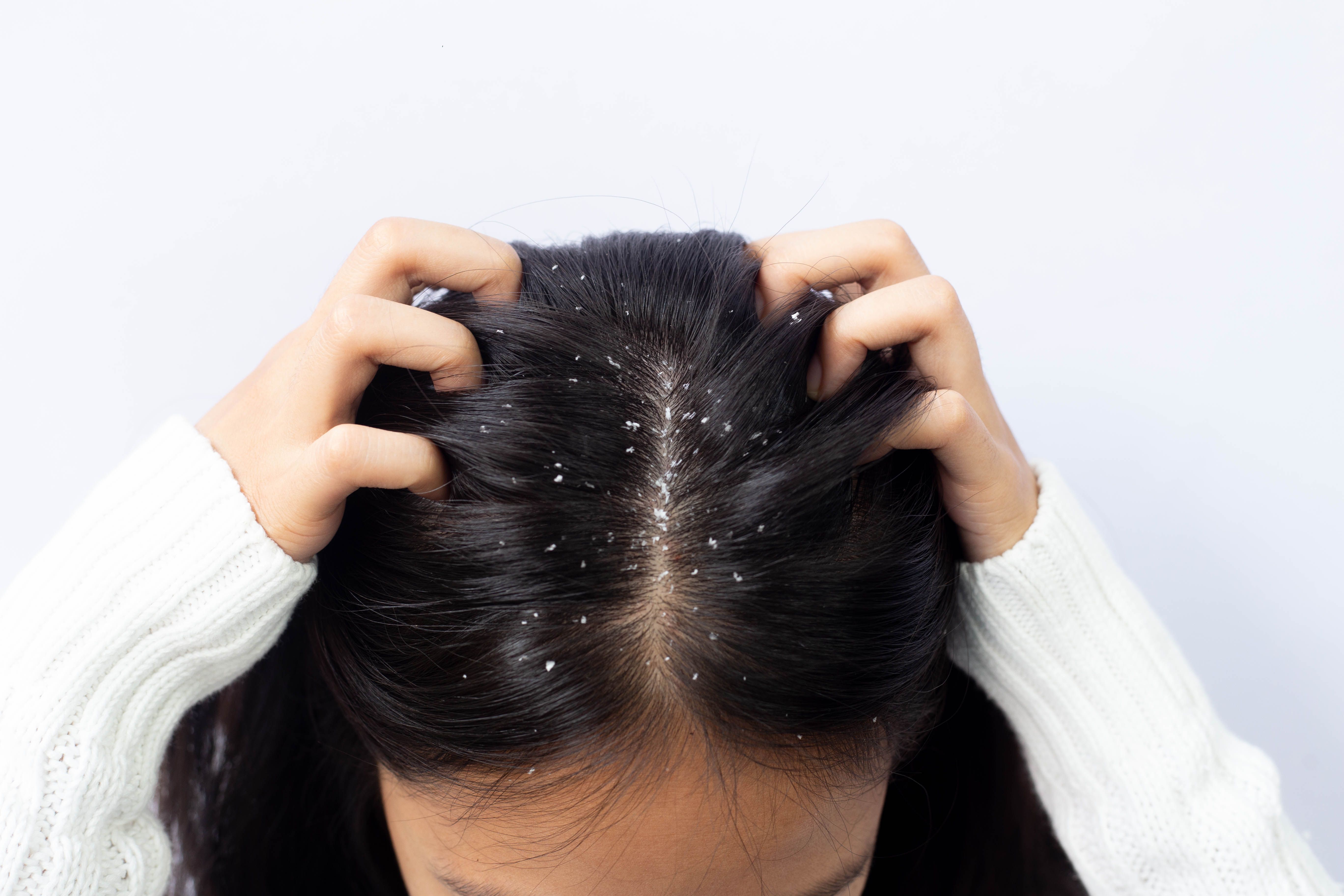 Combats Dandruff