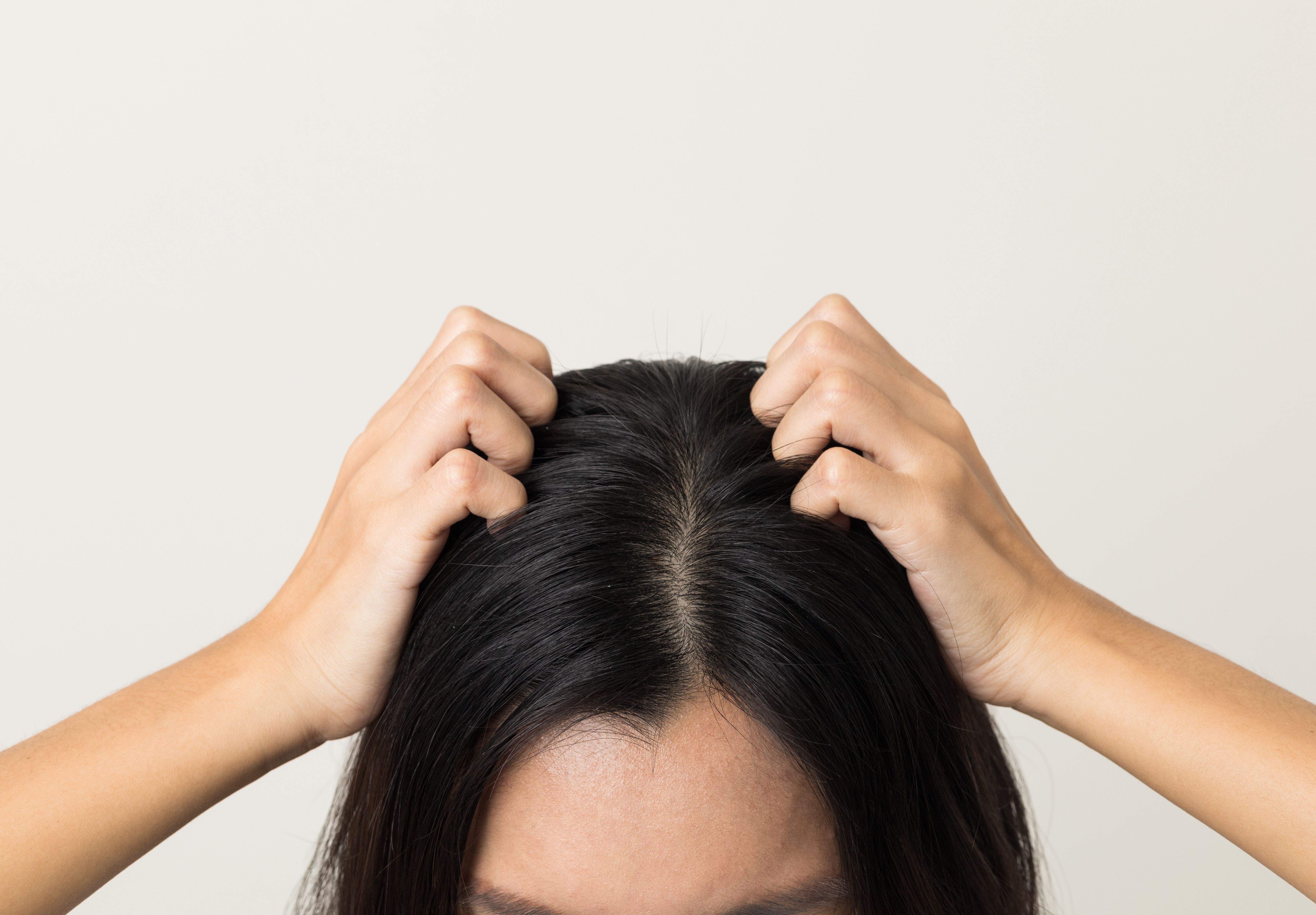What is scalp buildup