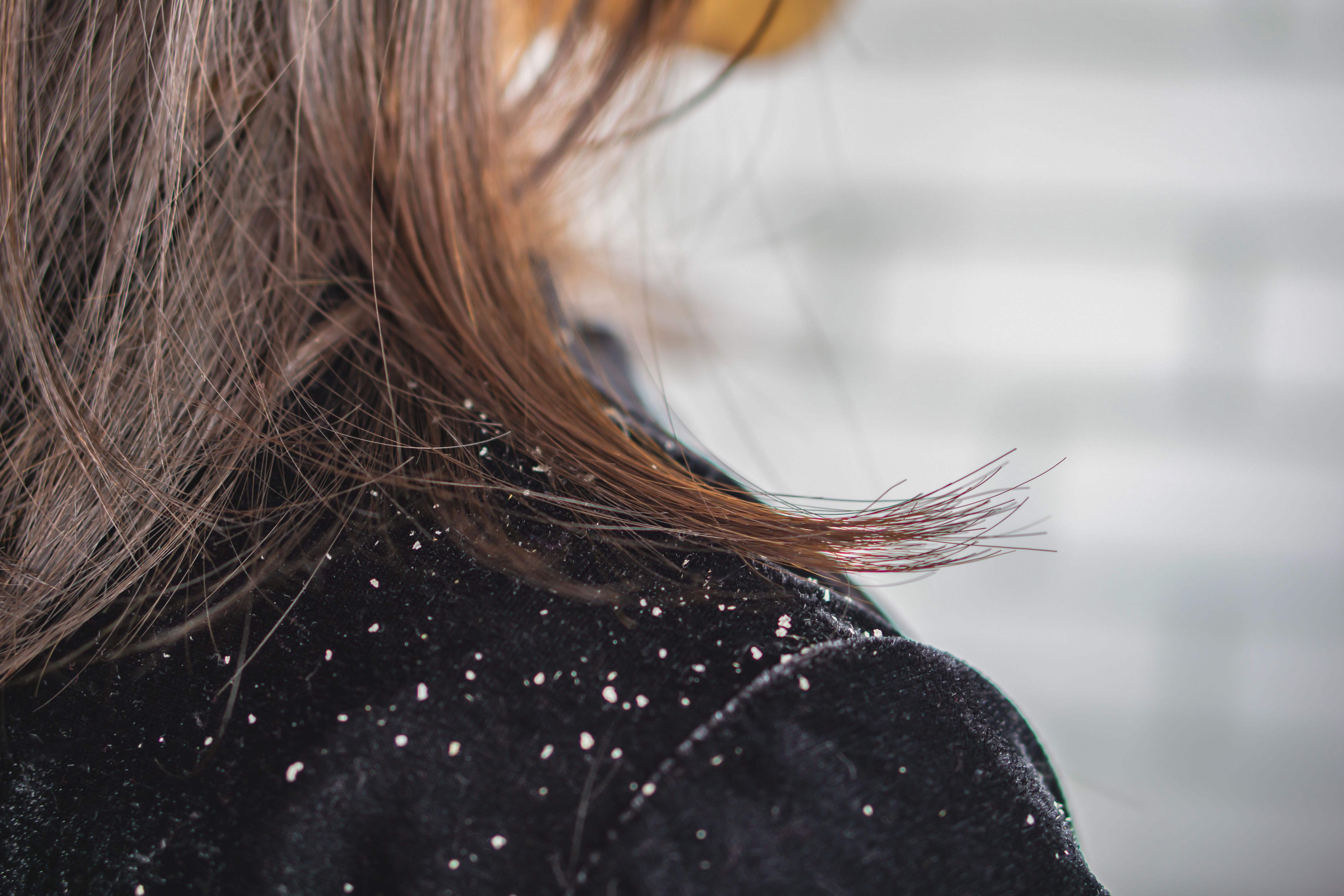 Dandruff in winter