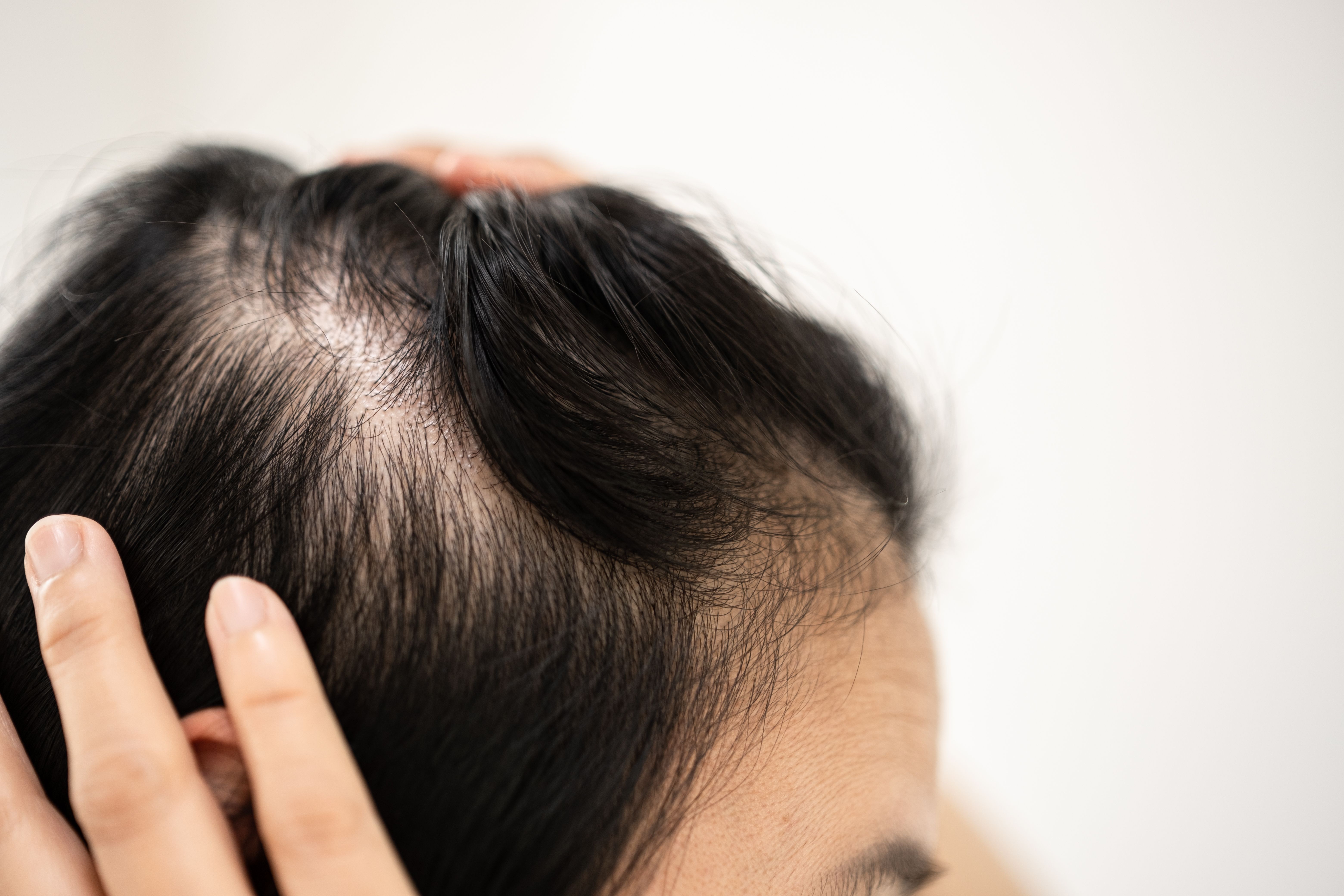 Causes of Hair Thinning
