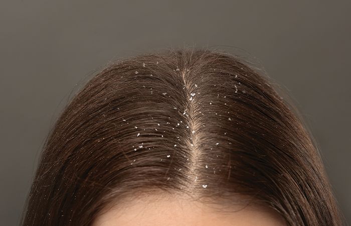 Dandruff in Monsoon