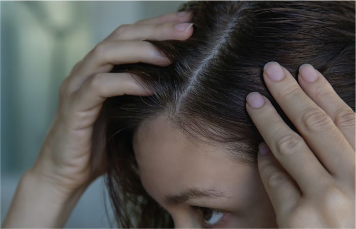 Winter Dry Scalp