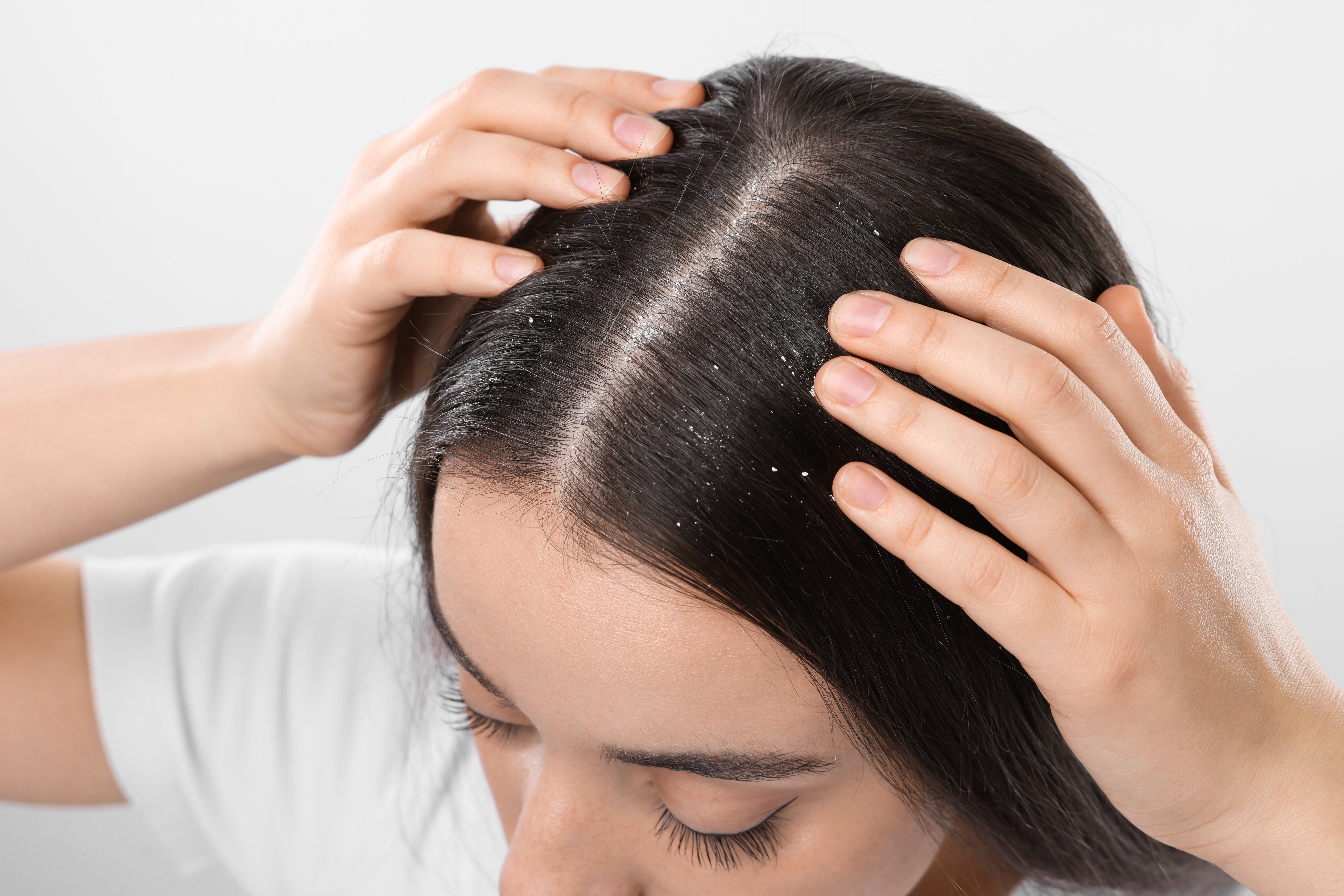 Dandruff from dry scalp