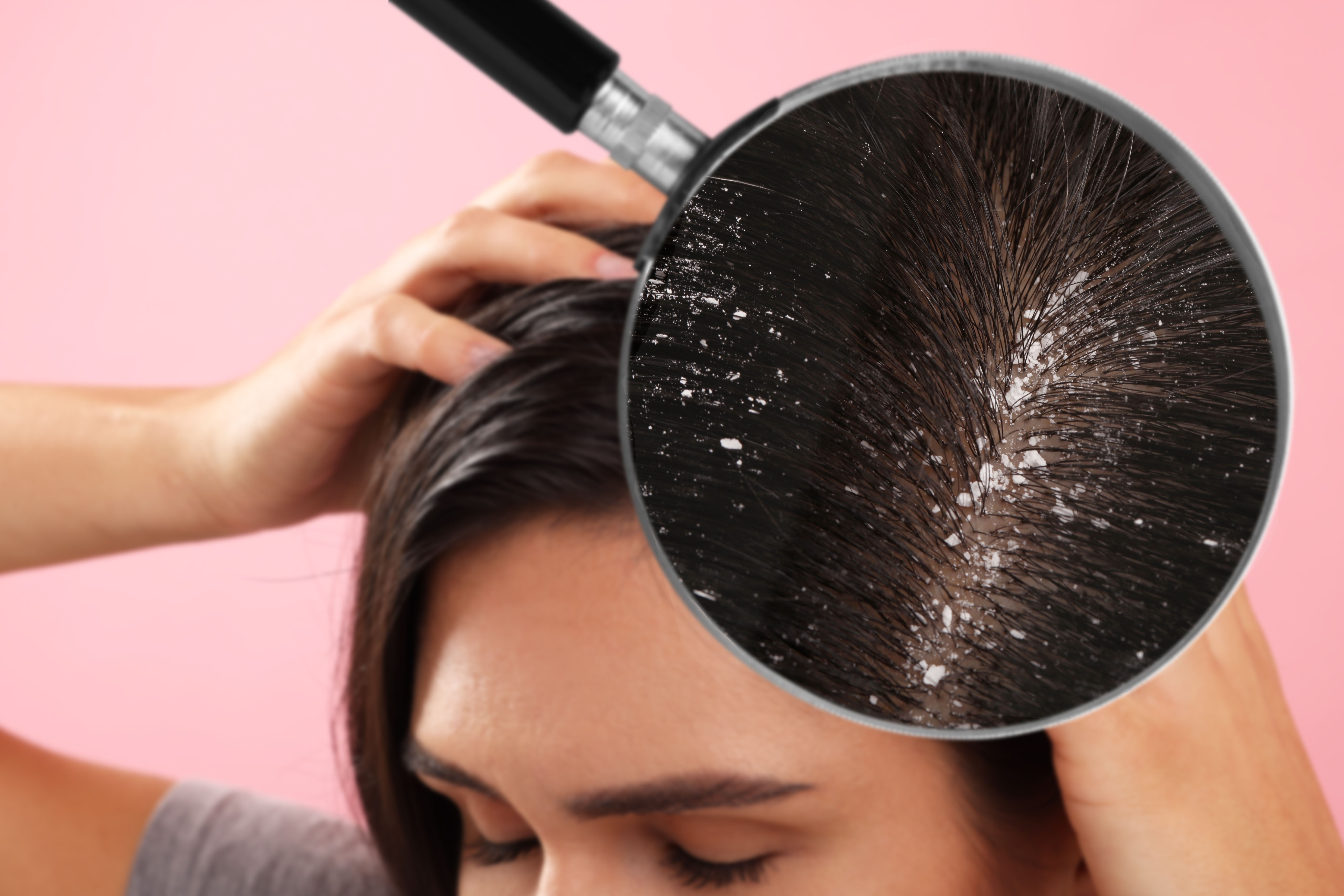Dandruff from oily skin