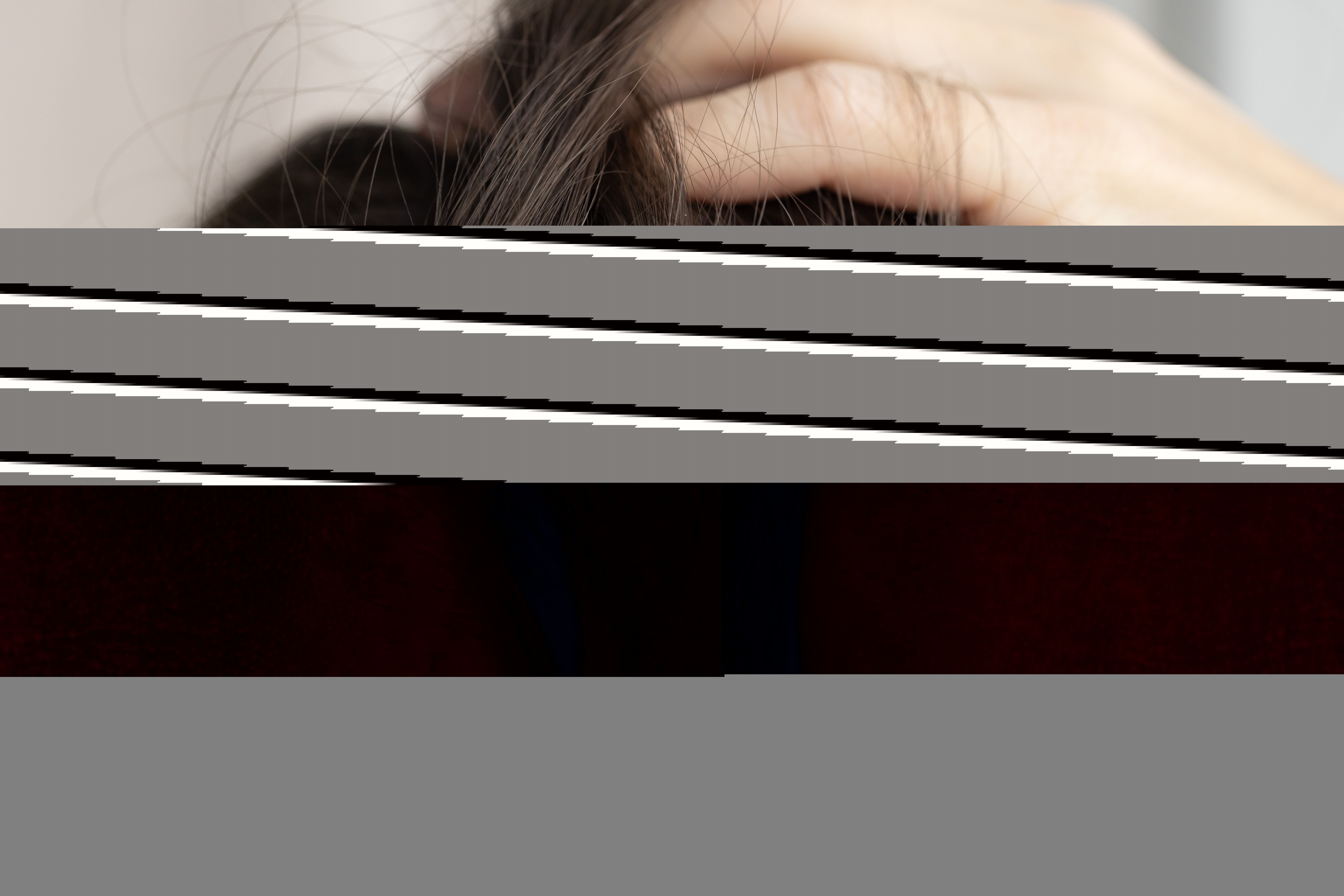 Fungus related dandruff