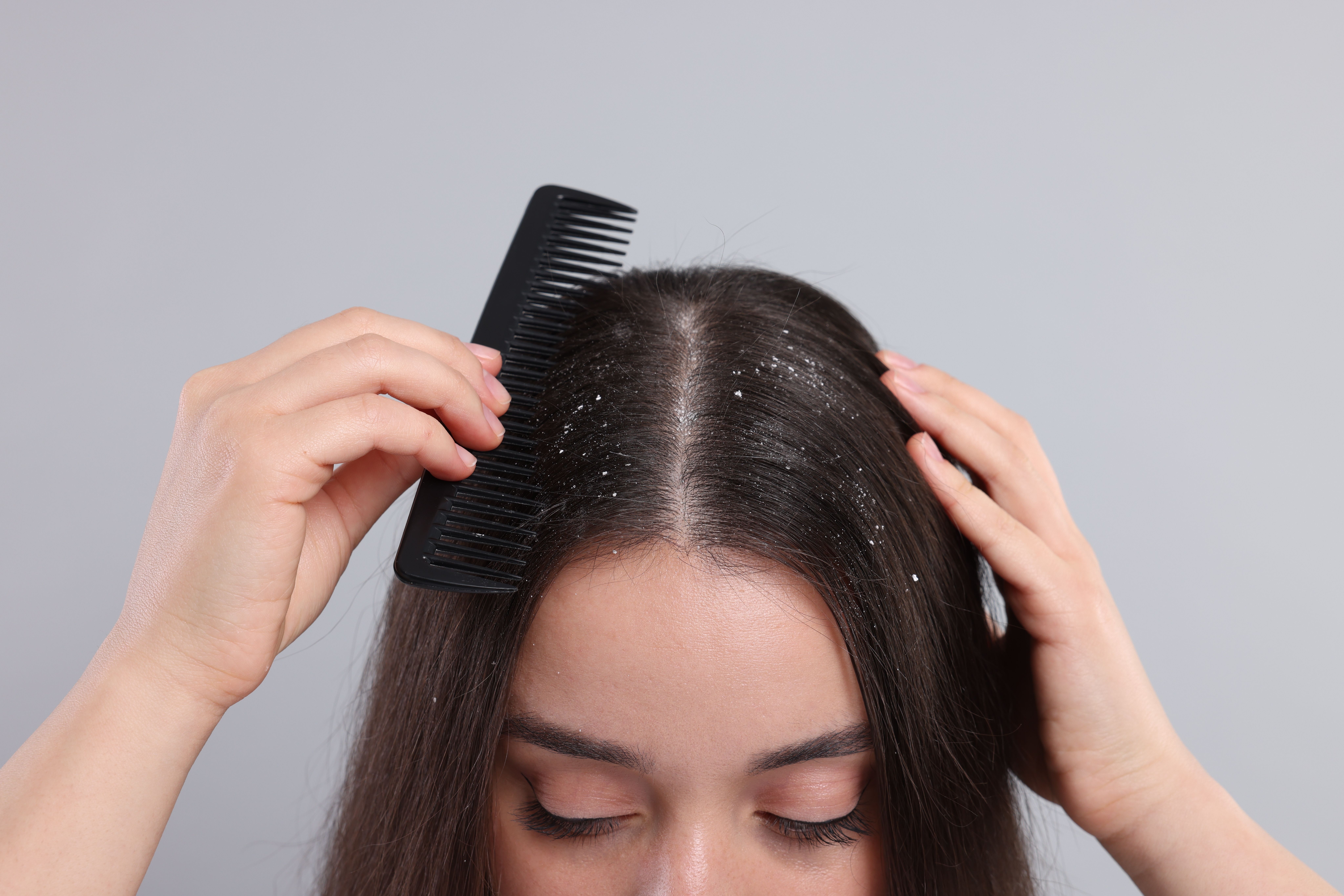 Causes of Dandruff in Summer